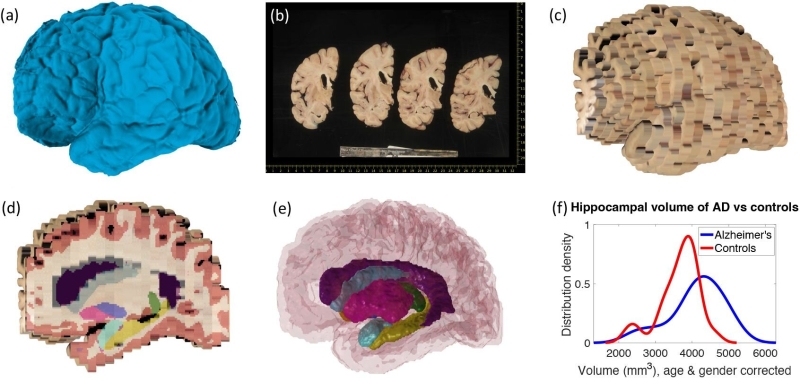 New computer system tools can rebuild 3D brain from biobank images