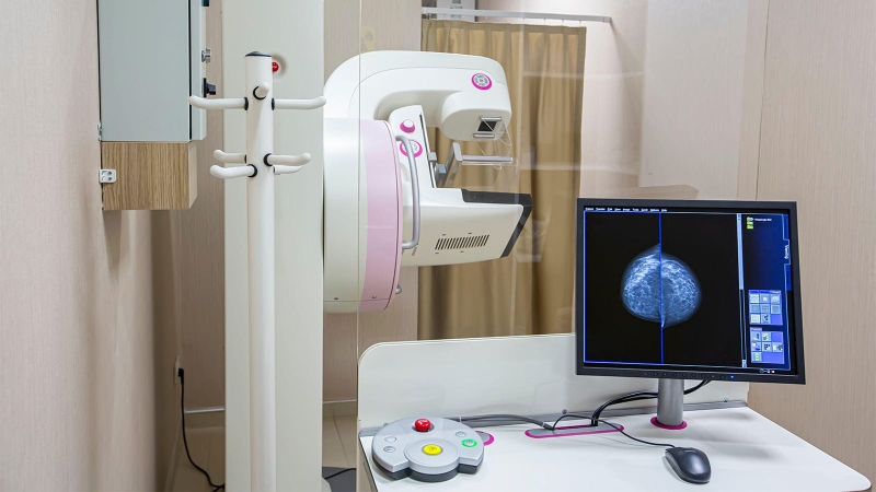 Yearly Breast Cancer Screening Starting at Age 40 Best, Modeling Study Says