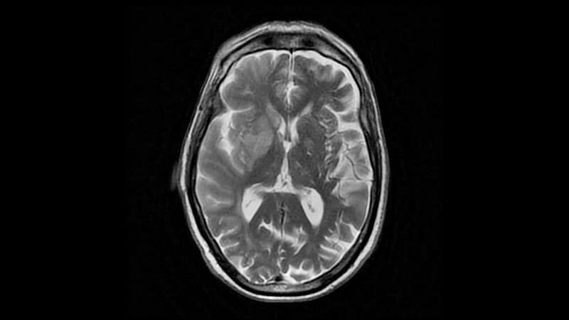 Thrombectomy Benefits Large Core Stroke Out to 1 Year