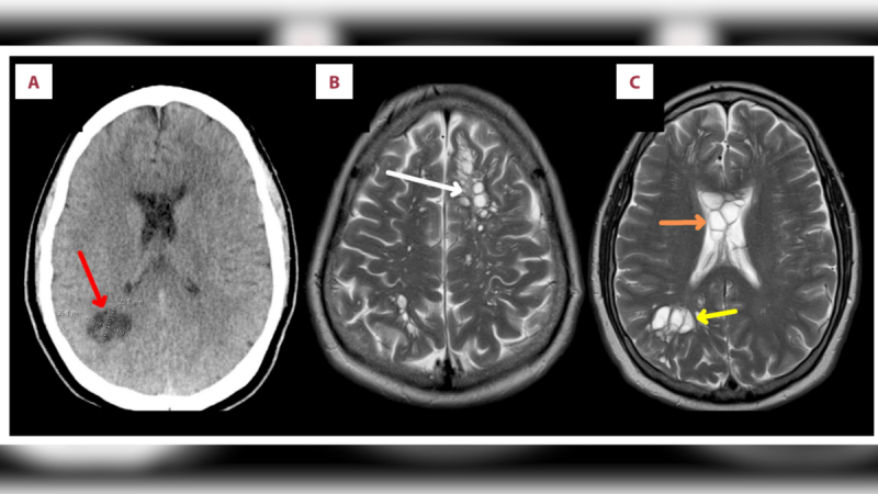 Parasitic worms discovered in guy’s brain after he likely consumed undercooked bacon