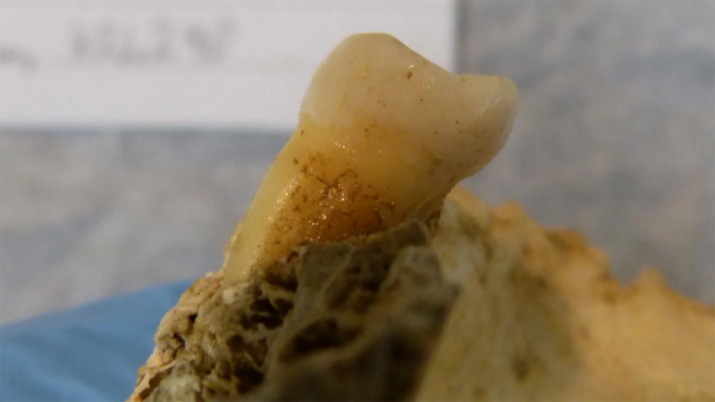 Unusual traces of dental caries and gum illness discovered in Bronze Age teeth