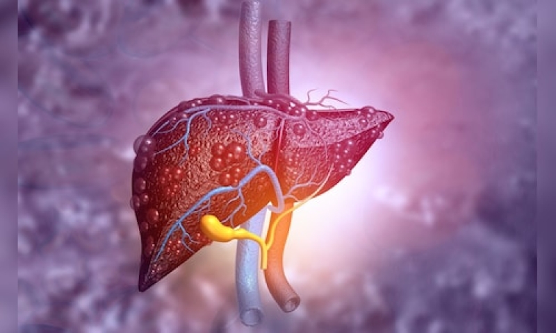 International Fatty Liver Day|The increasing danger of liver illness– why screening matters