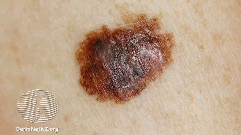 Does Dabrafenib-Trametinib Improve Survival in Melanoma?