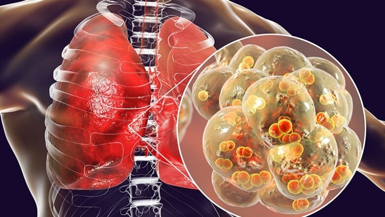 Particular Antipsychotics Linked to Increased Pneumonia Risk