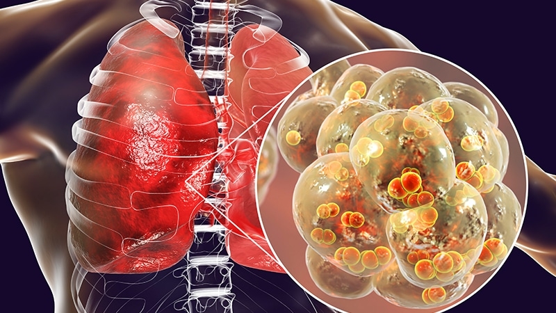 Particular Antipsychotics Linked to Increased Pneumonia Risk