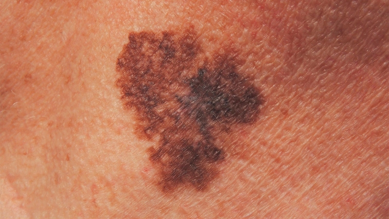 Can Narrow Margins Suffice for Some Smaller Low-Risk Melanomas In Situ?