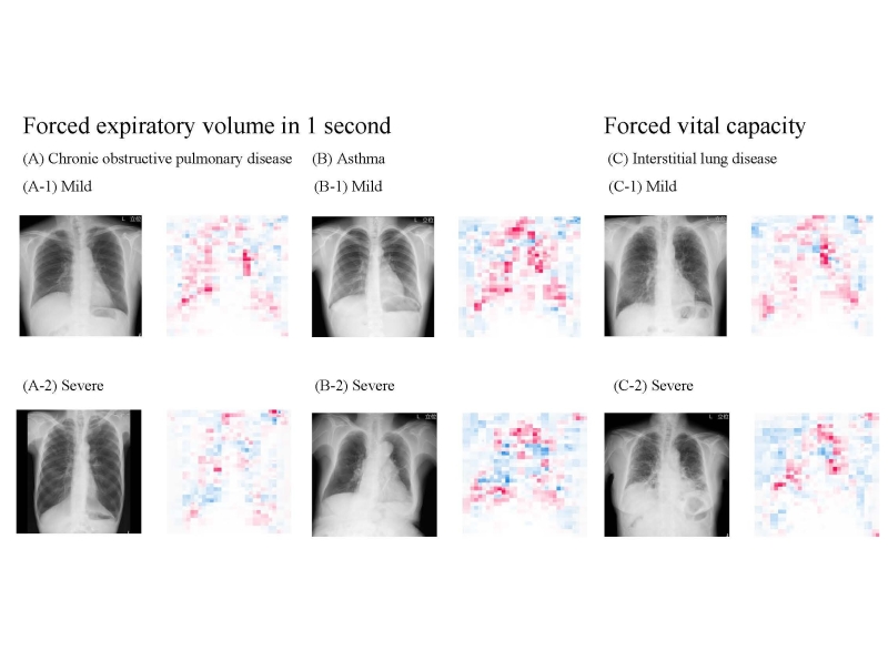 Extremely precise AI design can approximate lung function simply by utilizing chest X-rays