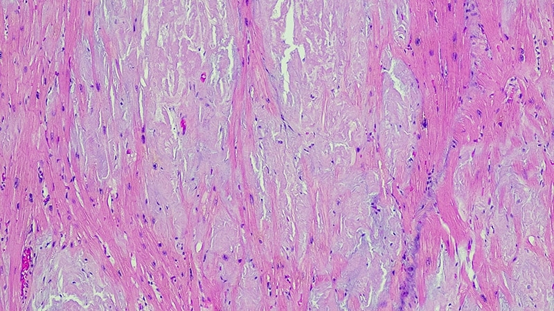 Promising Results for Vutrisiran in Cardiac Amyloidosis