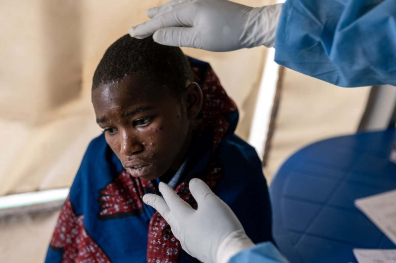 How fatal is mpox and what treatments are readily available?