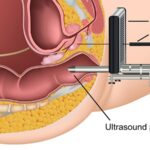 Is This the very best Prostate Biopsy?