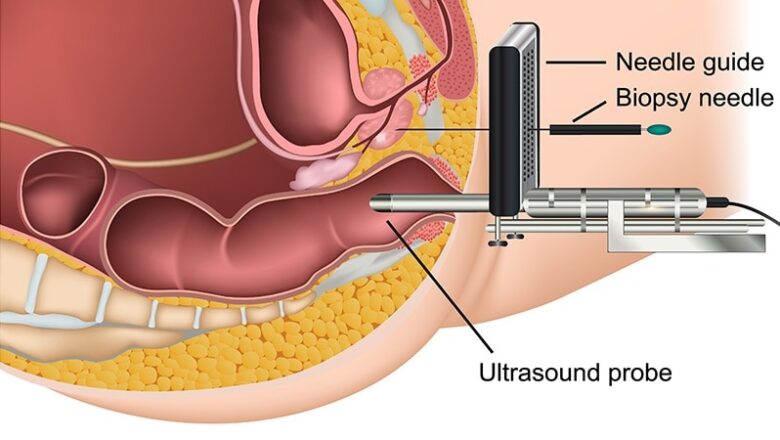 Is This the very best Prostate Biopsy?