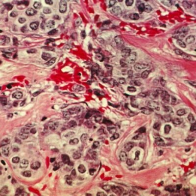 Research study validates fibrosis as a prognostic indication in the most typical breast cancer