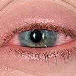 Adalimumab Tops Cyclosporine in Preventing Uveitis Relapse