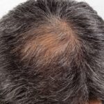 Irregular CCCA Hair Loss Remains Underappreciated