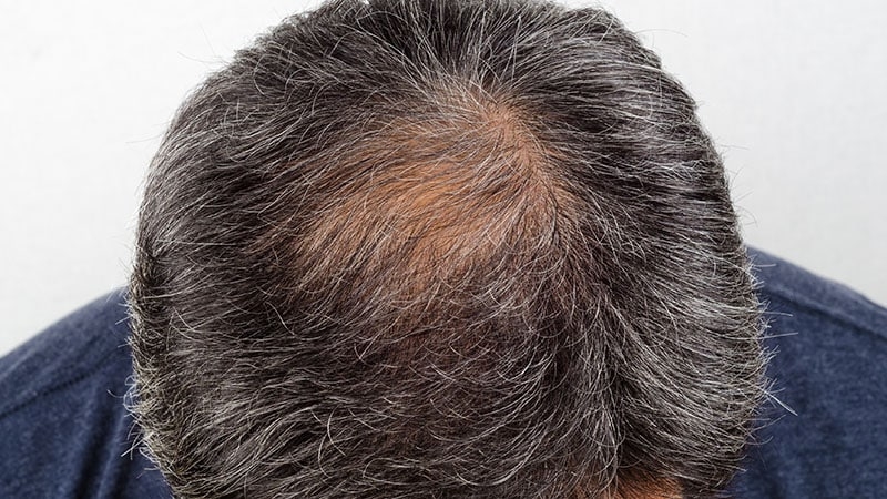 Irregular CCCA Hair Loss Remains Underappreciated