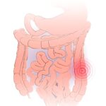 Stage II outcomes recommend targeted treatment works for moderate to serious ulcerative colitis