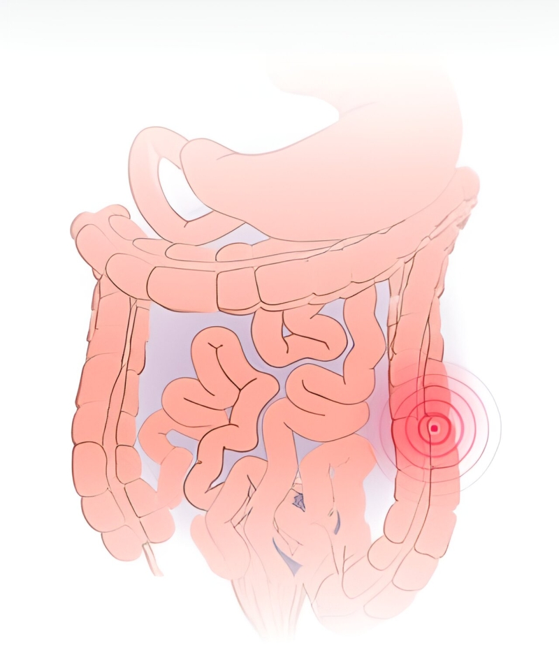 Stage II outcomes recommend targeted treatment works for moderate to serious ulcerative colitis