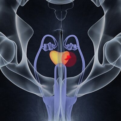 Which Biopsy for Elevated PSA?