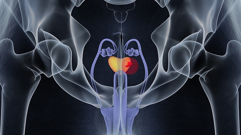 Which Biopsy for Elevated PSA?