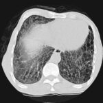 RA Lung Disease Subtypes Have Distinct Risk Factor Profiles