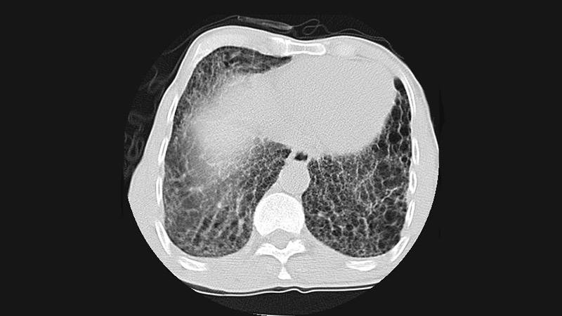 RA Lung Disease Subtypes Have Distinct Risk Factor Profiles