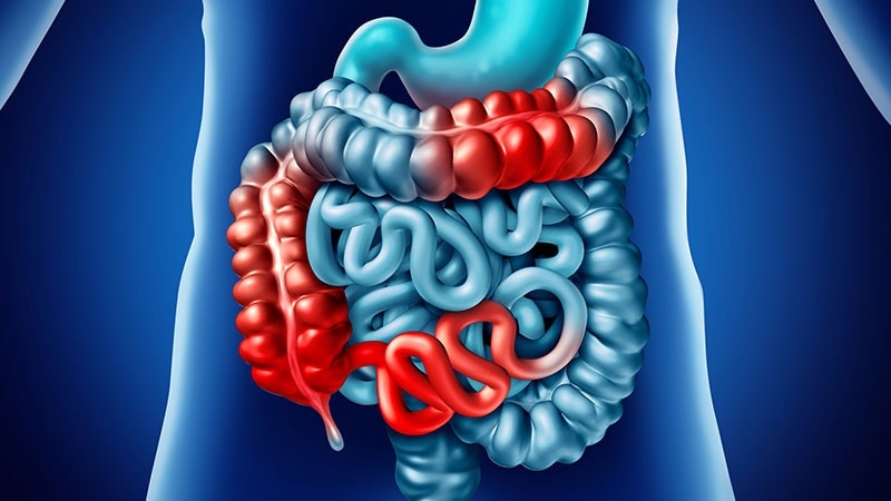 In Crohn’s Disease, Early Anti-TNF Levels May Be Crucial