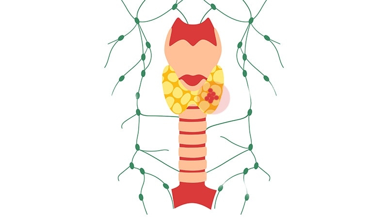 Lymph Node Yield Trades Off Surgery Risks in Thyroid Cancer