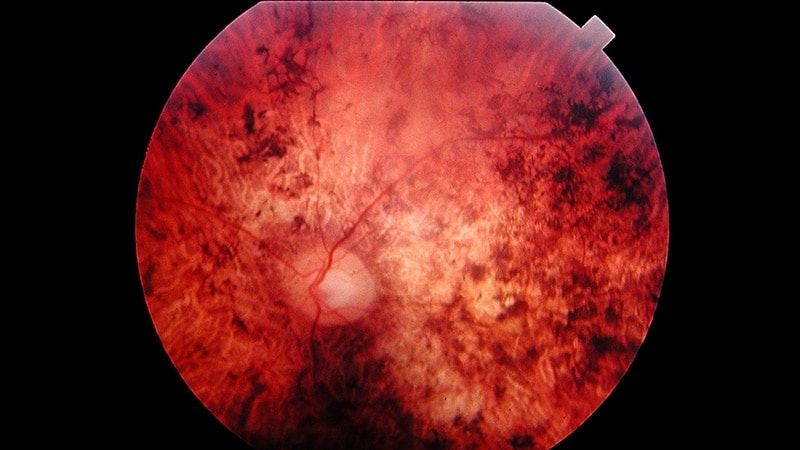 Does Race Affect Detection of Inherited Retinal Disease?