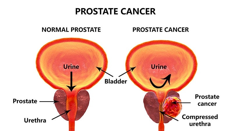 Complications After Prostate Cancer Treatment