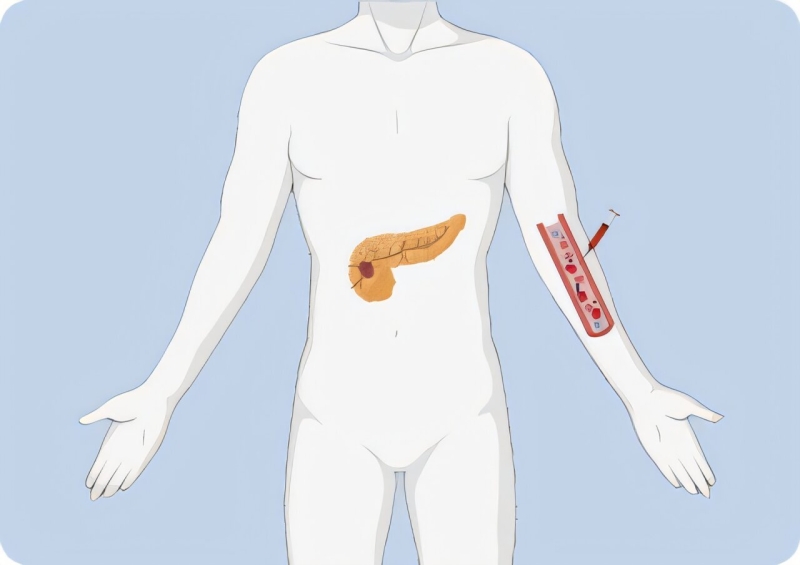 Liquid biopsy reveals prospective for pancreatic incidentaloma detection