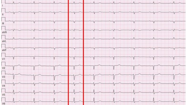 Cardiology cooperation advances maker finding out forecasts for AFib after stroke