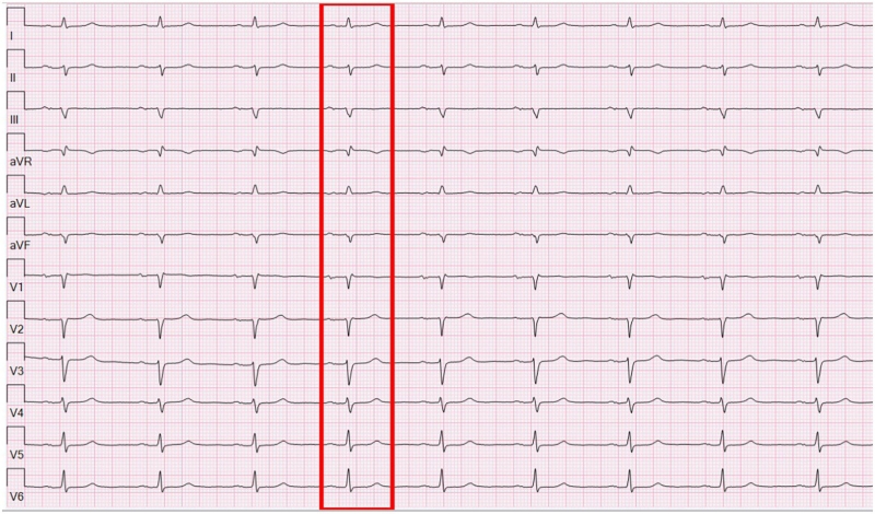 Cardiology cooperation advances maker finding out forecasts for AFib after stroke