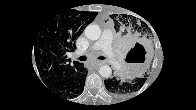 Lung Cancer Survival Improves in United States