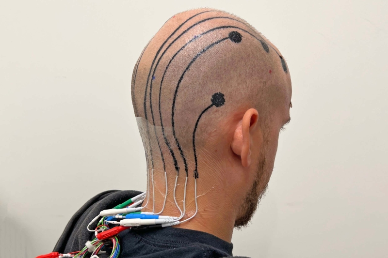 Short-term scalp tattoo can be utilized to tape-record brain activity