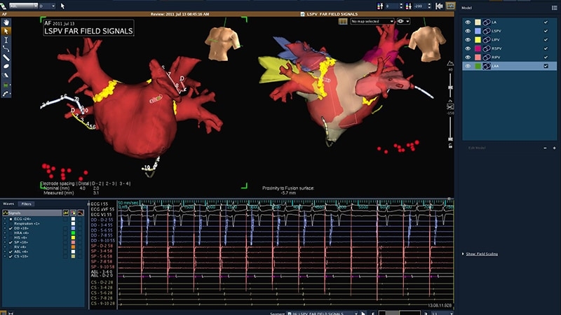 Catheter AF Ablation Growing in Popularity and Complexity