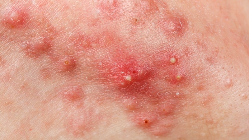 Specialist Discusses the ‘Four Pillars of Acne Pathogenesis’