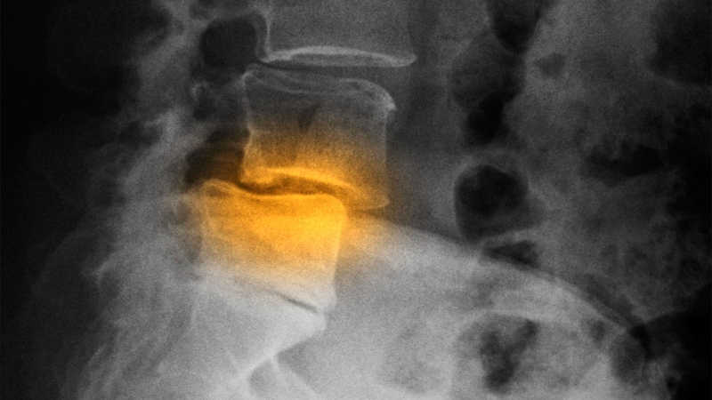 What Is Spondylolisthesis, the Spine Condition Reported to Plague Luigi Mangione?