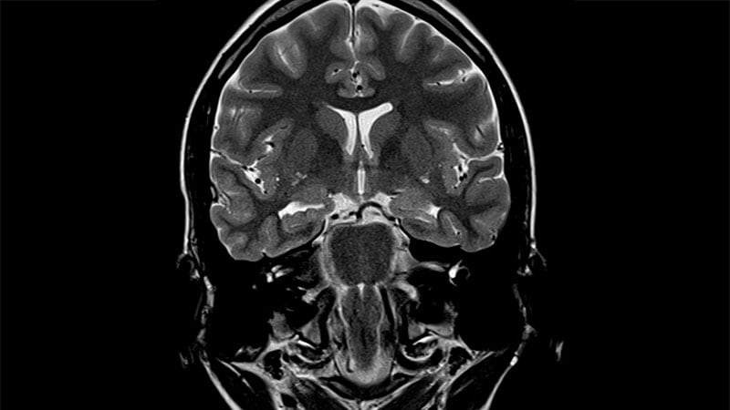 AI Catches Missing MRI Lesions