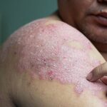 Psoriasis Affects an Estimated 3% of United States Adults