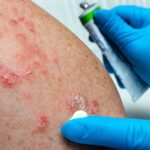 Integrated Psoriasis/PsA Clinics: Potential and Pitfalls