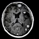 Preoperative Radiosurgery for Brain Metastases Shows Promise