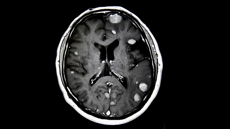 Preoperative Radiosurgery for Brain Metastases Shows Promise