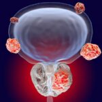 PSMA-PET Challenges Current Prostate Cancer Staging