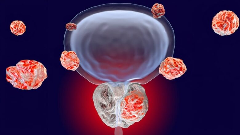 PSMA-PET Challenges Current Prostate Cancer Staging