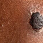 Youth Cancer Survivors Have Double the Risk of Melanoma as Adults