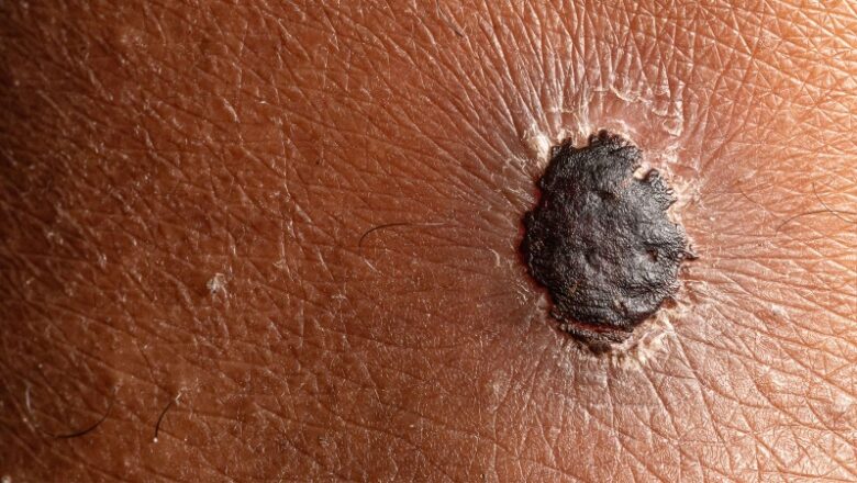 Youth Cancer Survivors Have Double the Risk of Melanoma as Adults